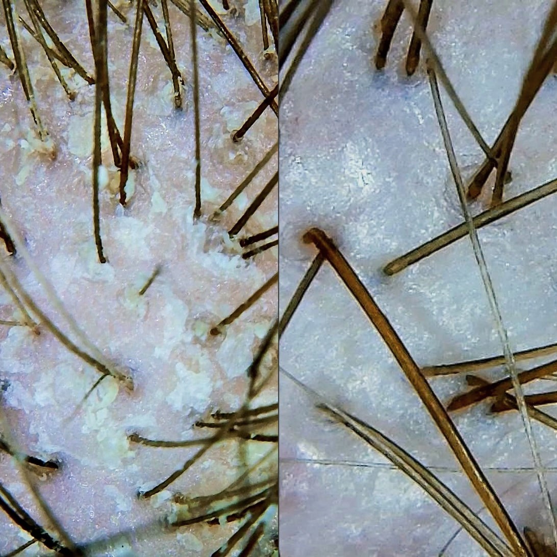 Scalp Analysis